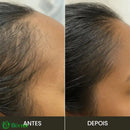 Escova de Terapia Capilar: TheraBrush Smarts 4 em 1 Escova Laser Antiqueda TheraBrush | 1 Unidade Escova Laser